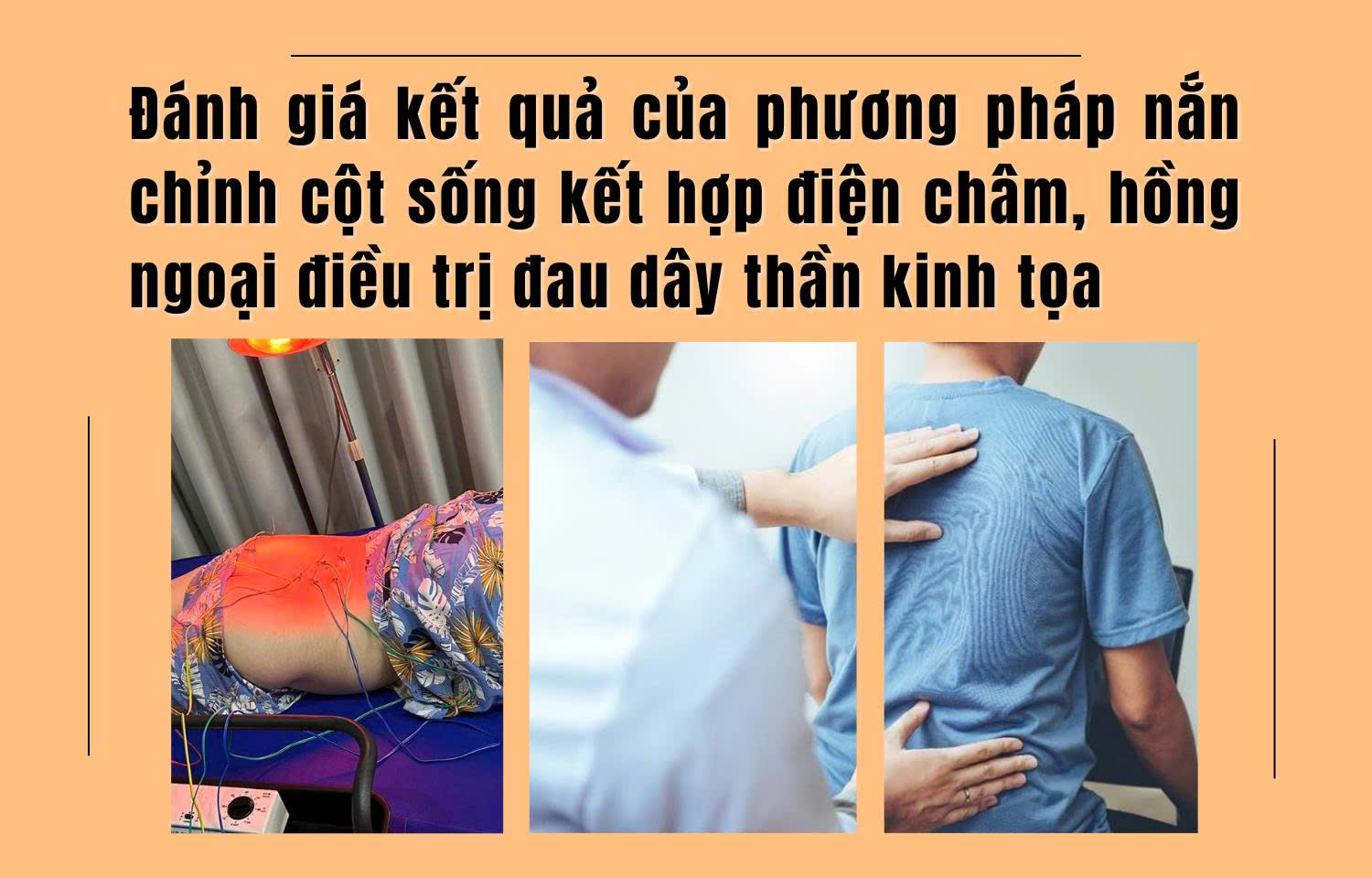 Đánh giá kết quả của phương pháp nắn chỉnh cột sống kết hợp điện châm, hồng ngoại điều trị đau dây thần kinh tọa