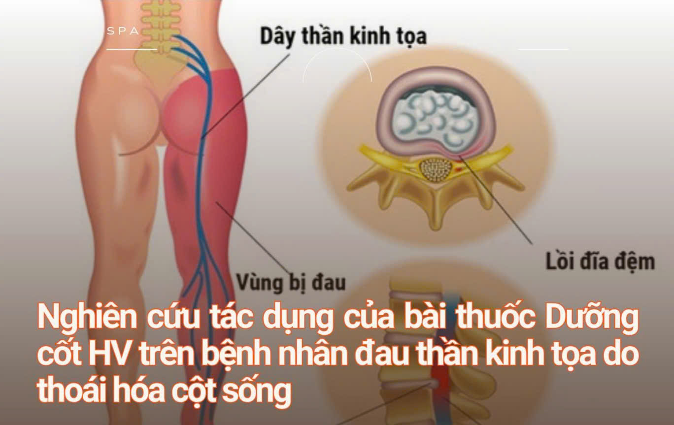 Nghiên cứu tác dụng của bài thuốc Dưỡng cốt HV trên bệnh nhân đau thần kinh tọa do thoái hóa cột sống